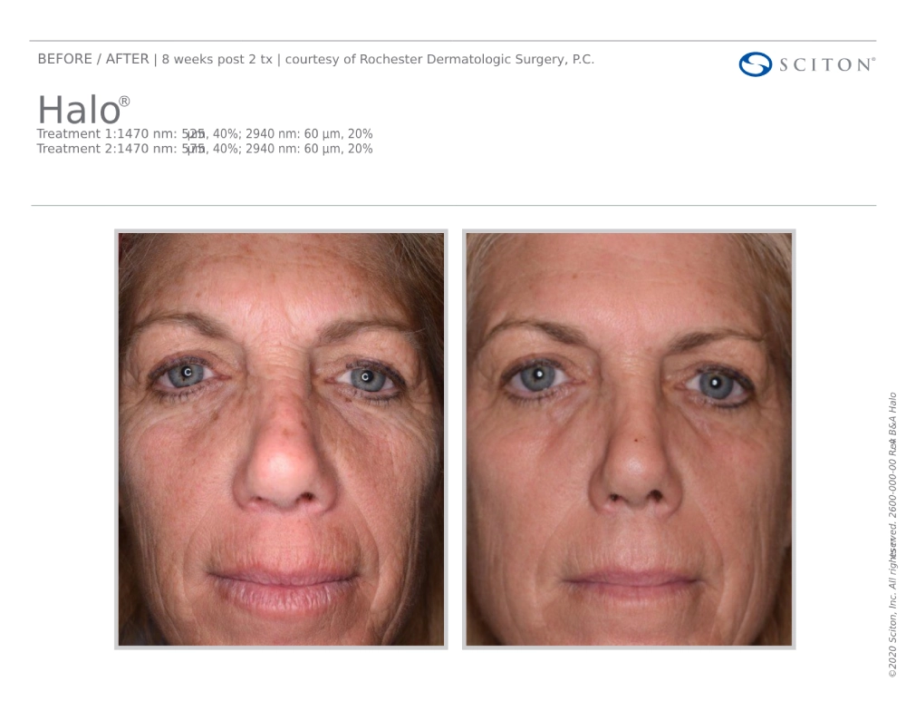 House-Regenerative-Med-Spa-Halo®-Laser-Treatment-Before-After-Image-A-in-Chicago-IL