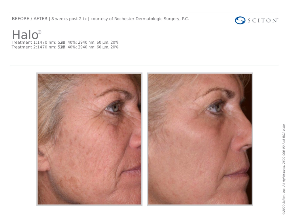 House-Regenerative-Med-Spa-Halo®-Laser-Treatment-Before-After-Image-B-in-Chicago-IL