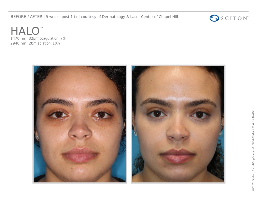 House-Regenerative-Med-Spa-Halo®-Laser-Treatment-Before-After-Image-C-in-Chicago-IL