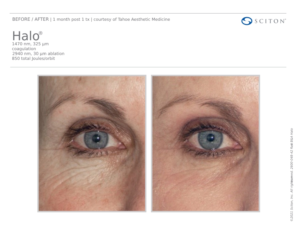 House-Regenerative-Med-Spa-Halo®-Laser-Treatment-Before-After-Image-D-in-Chicago-IL