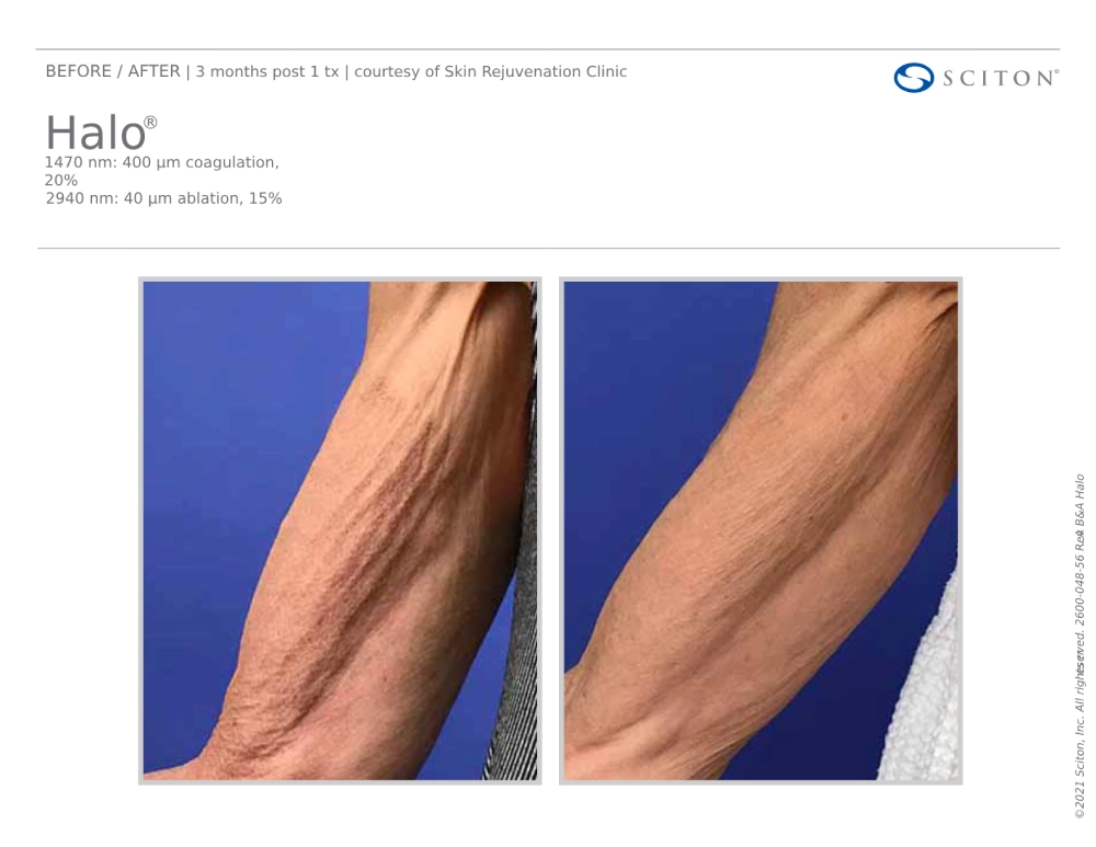 House-Regenerative-Med-Spa-Halo®-Laser-Treatment-Before-After-Image-E-in-Chicago-IL