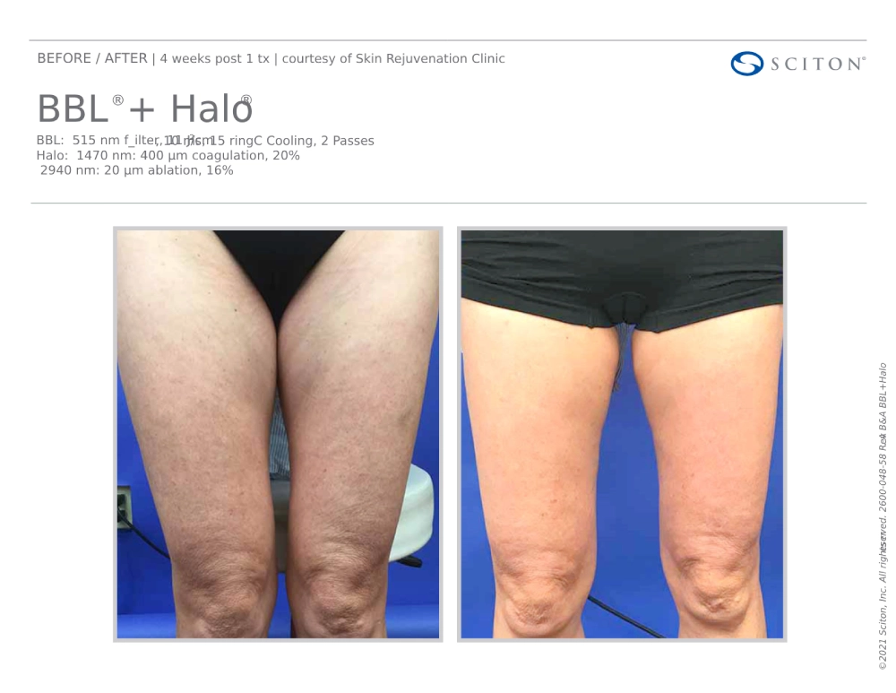 House-Regenerative-Med-Spa-Halo®-Laser-Treatment-Before-After-Image-F-in-Chicago-IL