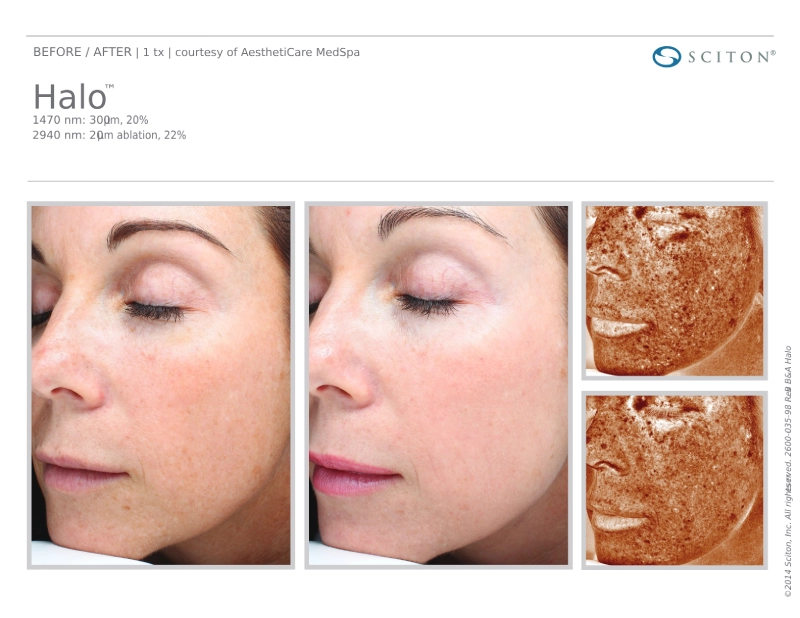 House-Regenerative-Med-Spa-Halo®-Laser-Treatment-Before-After-Image-G-in-Chicago-IL