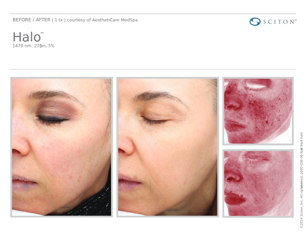 House-Regenerative-Med-Spa-Halo®-Laser-Treatment-Before-After-Image-H-in-Chicago-IL