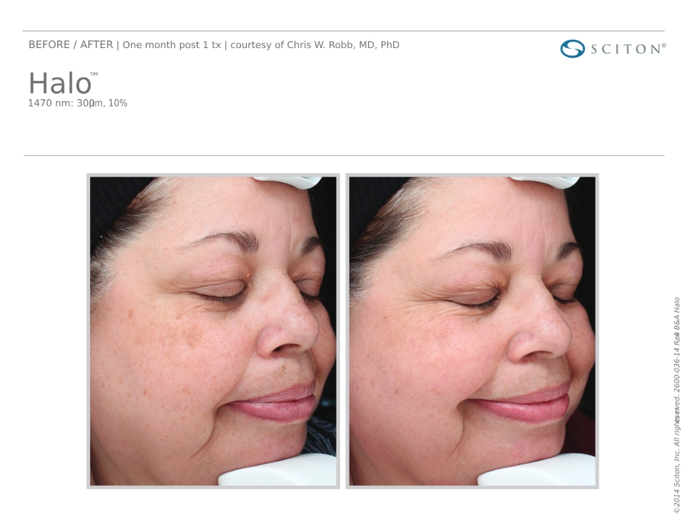 House-Regenerative-Med-Spa-Halo®-Laser-Treatment-Before-After-Image-I-in-Chicago-IL