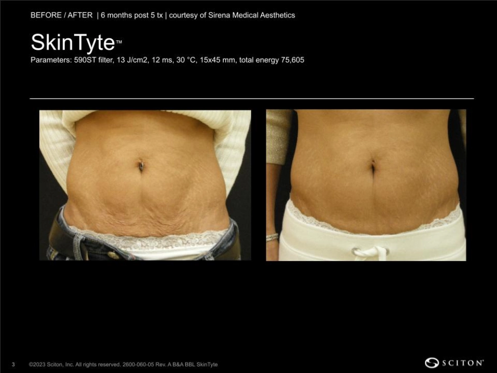 House-Regenerative-Med-Spa-SkinTyte®-By-Sciton-Abdomen-Before-After-Image-A-in-Chicago-IL