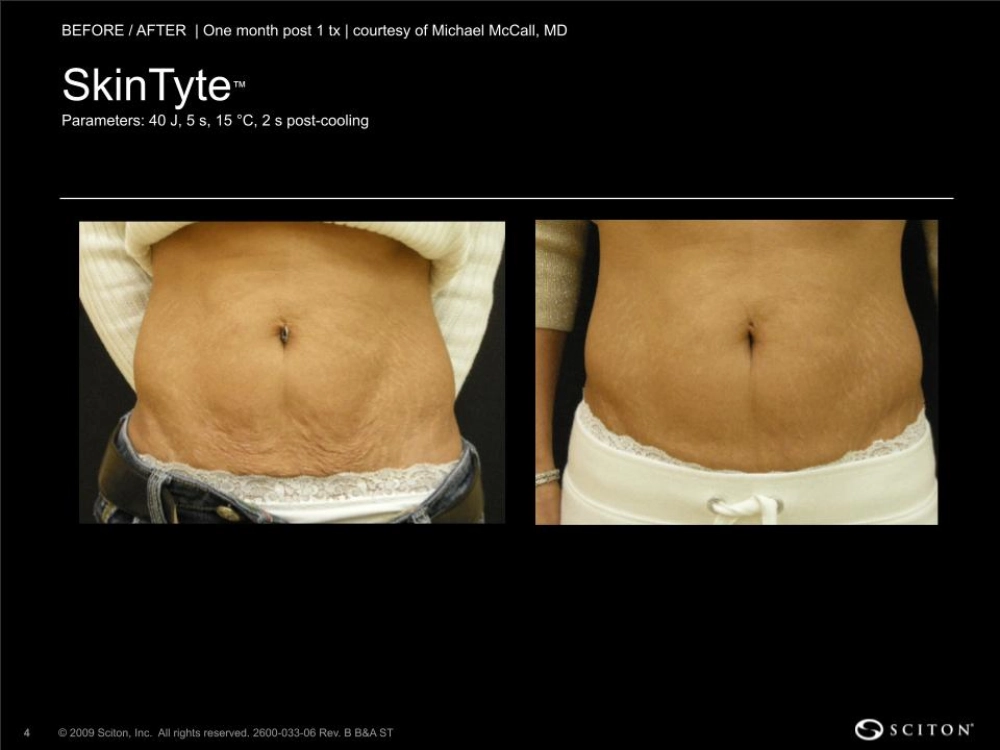 House-Regenerative-Med-Spa-SkinTyte®-By-Sciton-Abdomen-Before-After-Image-B-in-Chicago-IL