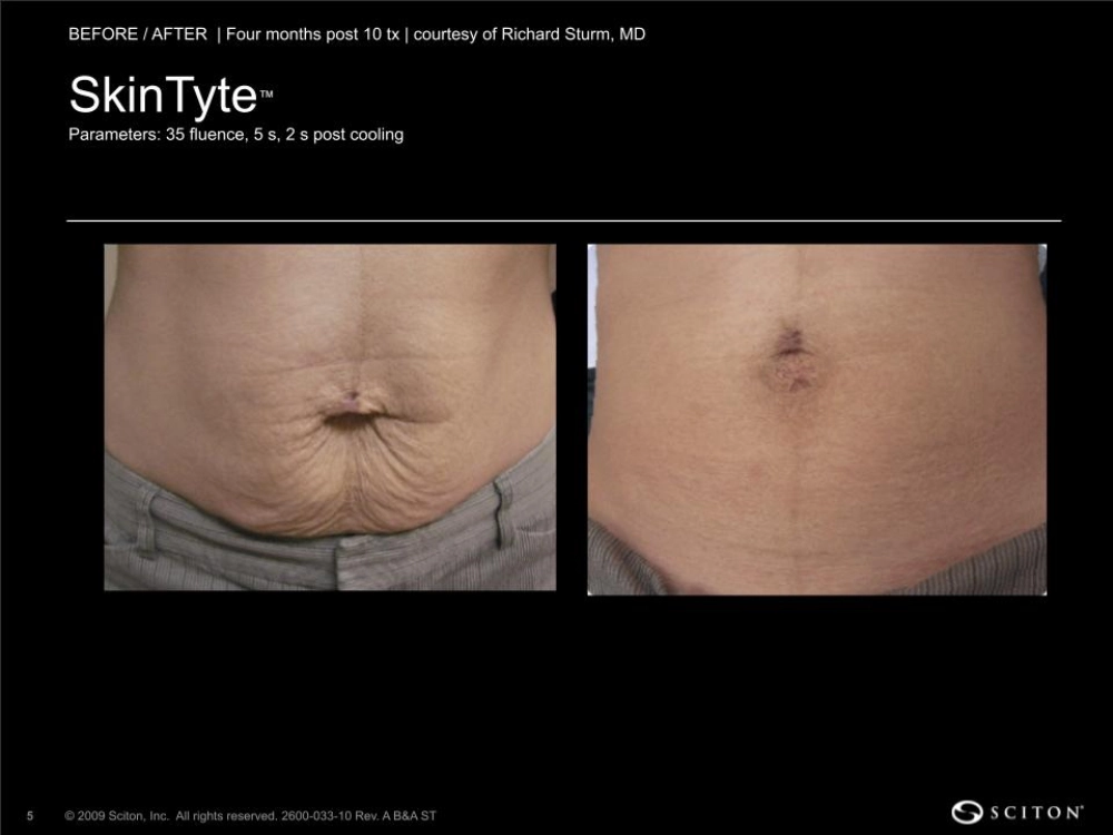 House-Regenerative-Med-Spa-SkinTyte®-By-Sciton-Abdomen-Before-After-Image-C-in-Chicago-IL