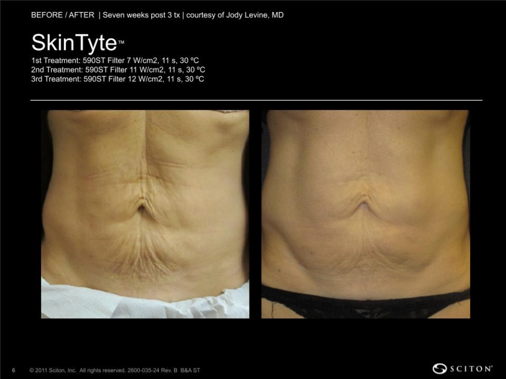 House-Regenerative-Med-Spa-SkinTyte®-By-Sciton-Abdomen-Before-After-Image-D-in-Chicago-IL