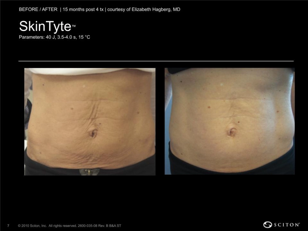 House-Regenerative-Med-Spa-SkinTyte®-By-Sciton-Abdomen-Before-After-Image-E-in-Chicago-IL