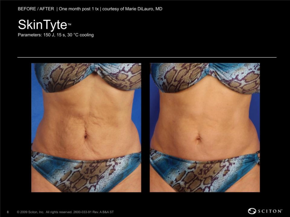 House-Regenerative-Med-Spa-SkinTyte®-By-Sciton-Abdomen-Before-After-Image-F-in-Chicago-IL