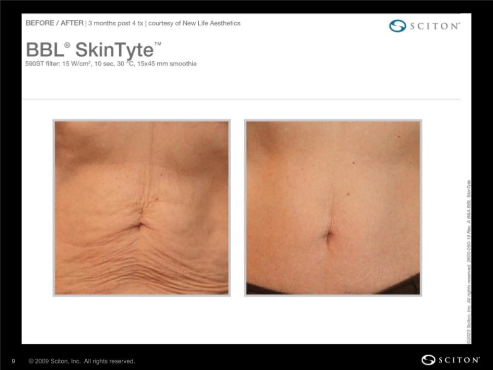 House-Regenerative-Med-Spa-SkinTyte®-By-Sciton-Abdomen-Before-After-Image-G-in-Chicago-IL