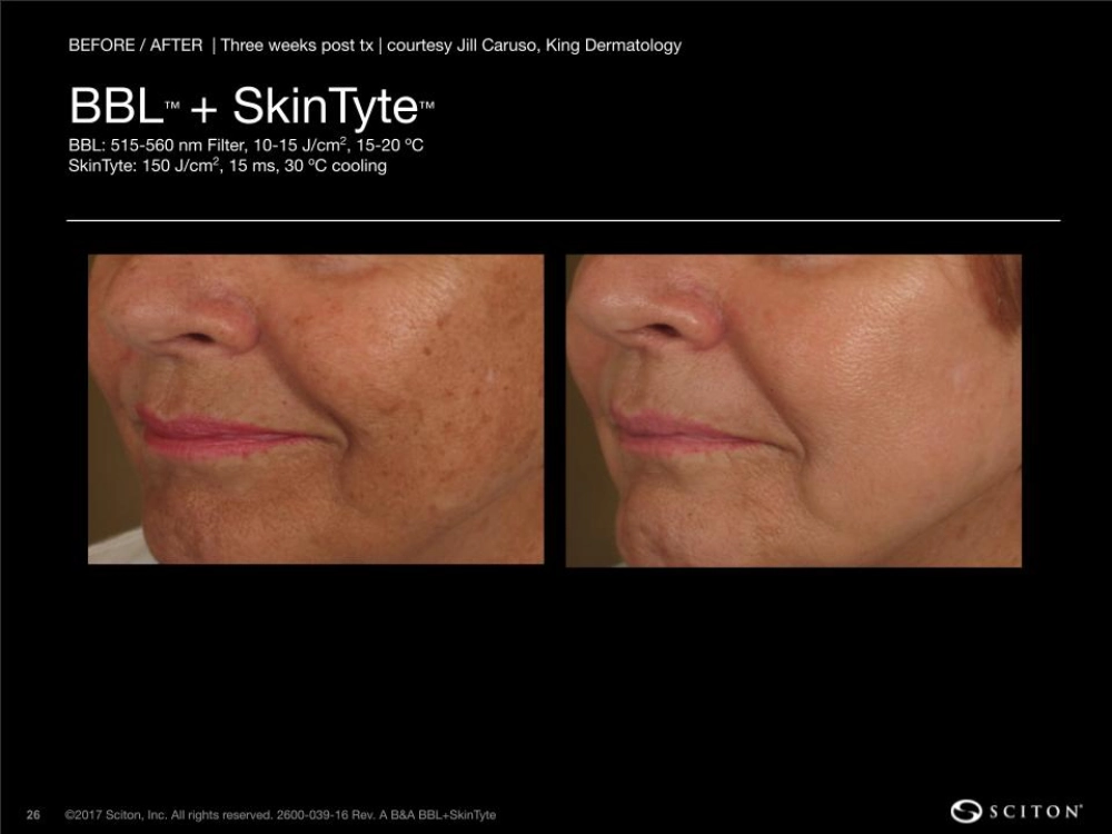 House-Regenerative-Med-Spa-SkinTyte®-By-Sciton-BBL-Before-After-Image-A-in-Chicago-IL