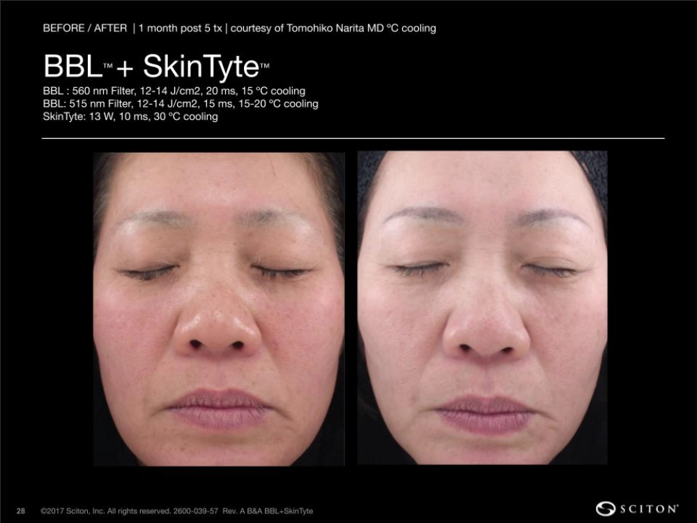 House-Regenerative-Med-Spa-SkinTyte®-By-Sciton-BBL-Before-After-Image-C-in-Chicago-IL