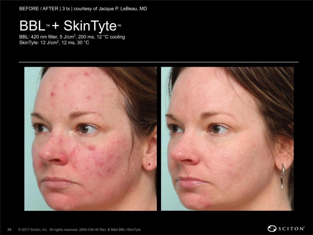 House-Regenerative-Med-Spa-SkinTyte®-By-Sciton-BBL-Before-After-Image-D-in-Chicago-IL