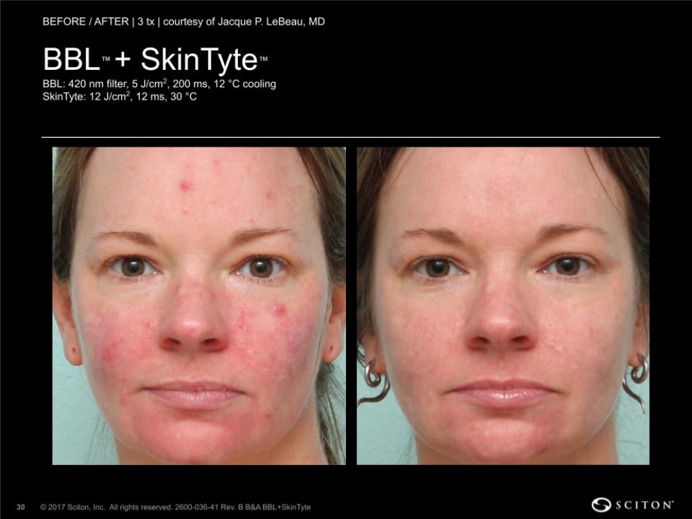 House-Regenerative-Med-Spa-SkinTyte®-By-Sciton-BBL-Before-After-Image-E-in-Chicago-IL