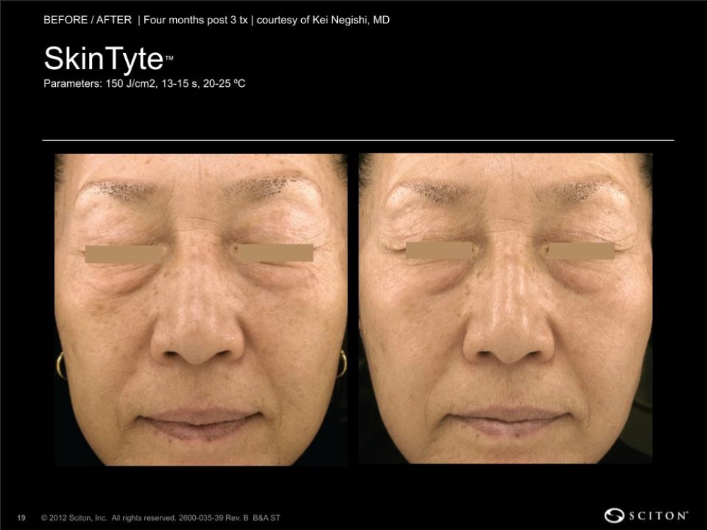 House-Regenerative-Med-Spa-SkinTyte®-By-Sciton-Face-Before-After-Image-A-in-Chicago-IL