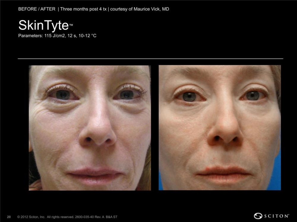 House-Regenerative-Med-Spa-SkinTyte®-By-Sciton-Face-Before-After-Image-B-in-Chicago-IL