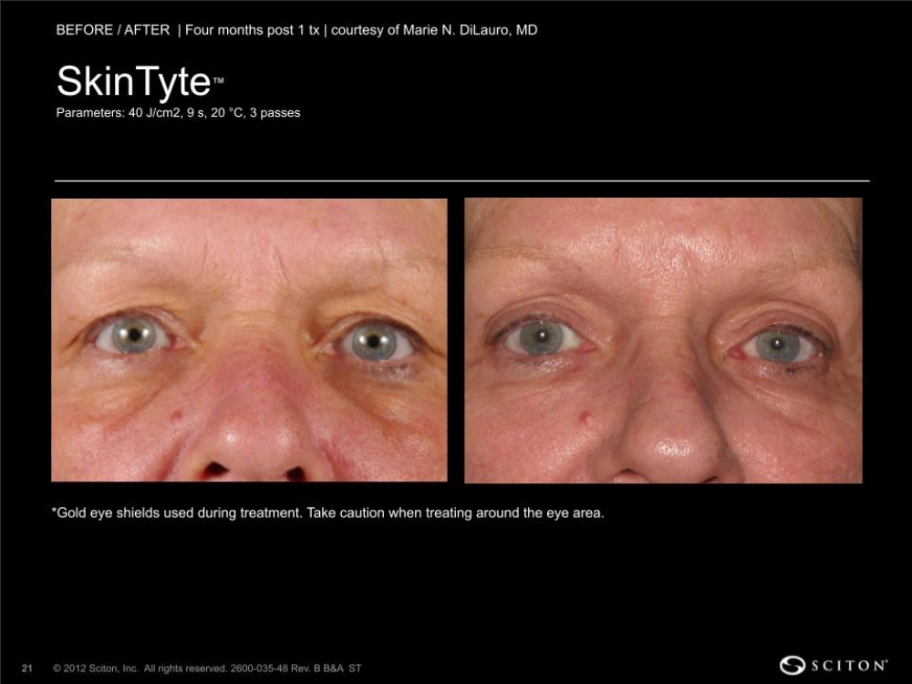 House-Regenerative-Med-Spa-SkinTyte®-By-Sciton-Face-Before-After-Image-C-in-Chicago-IL