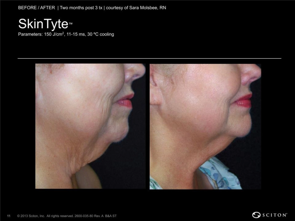 House-Regenerative-Med-Spa-SkinTyte®-By-Sciton-Neck-Before-After-Image-A-in-Chicago-IL