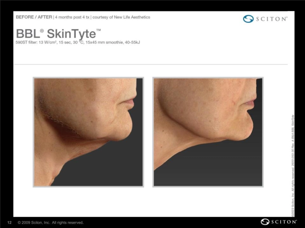 House-Regenerative-Med-Spa-SkinTyte®-By-Sciton-Neck-Before-After-Image-B-in-Chicago-IL