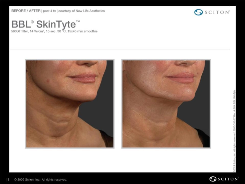 House-Regenerative-Med-Spa-SkinTyte®-By-Sciton-Neck-Before-After-Image-C-in-Chicago-IL