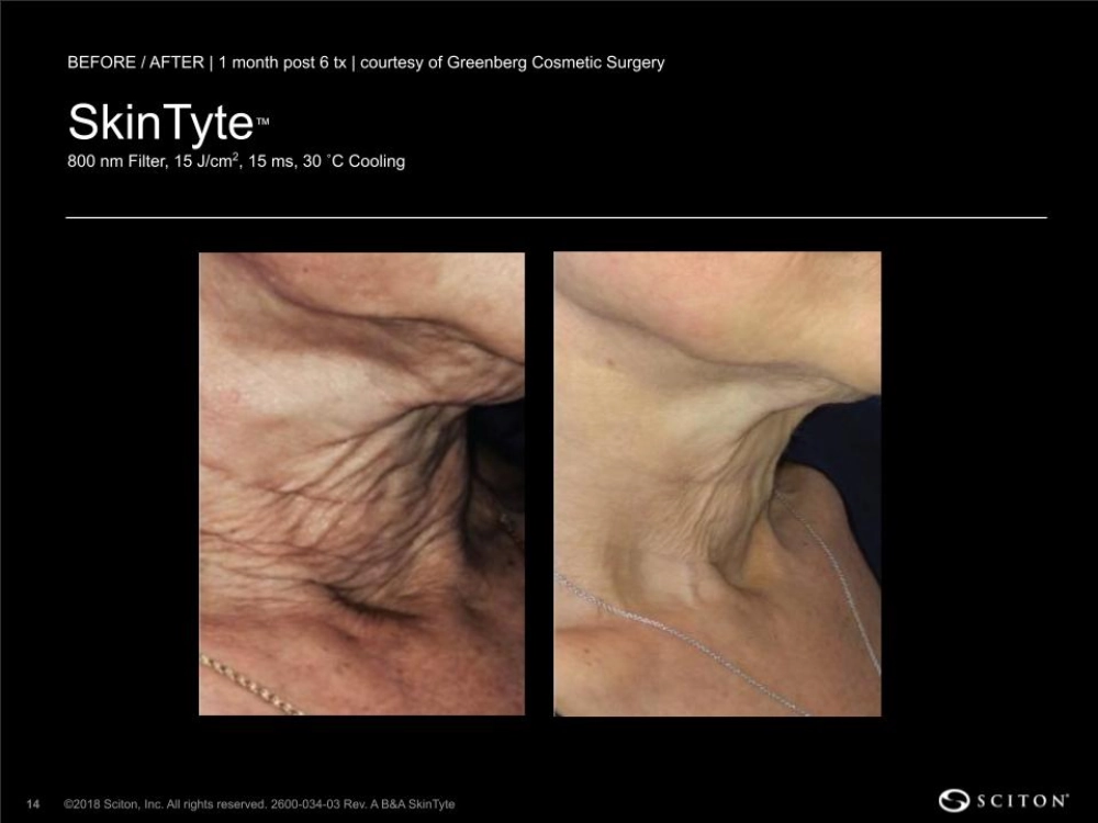 House-Regenerative-Med-Spa-SkinTyte®-By-Sciton-Neck-Before-After-Image-D-in-Chicago-IL