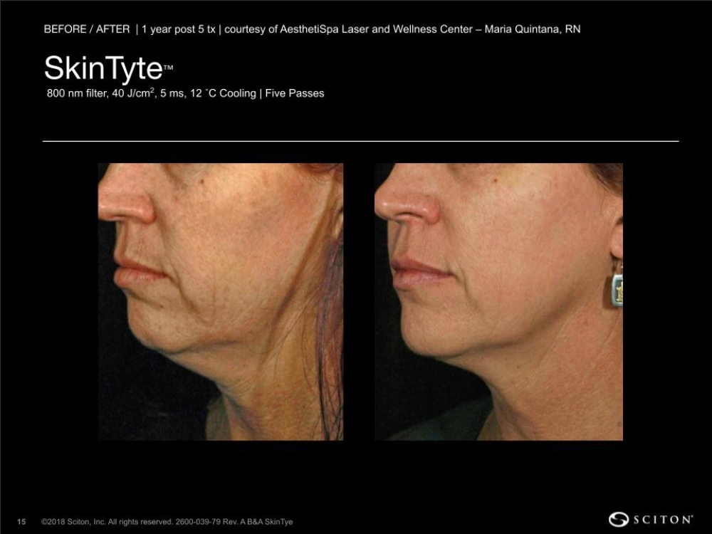 House-Regenerative-Med-Spa-SkinTyte®-By-Sciton-Neck-Before-After-Image-E-in-Chicago-IL