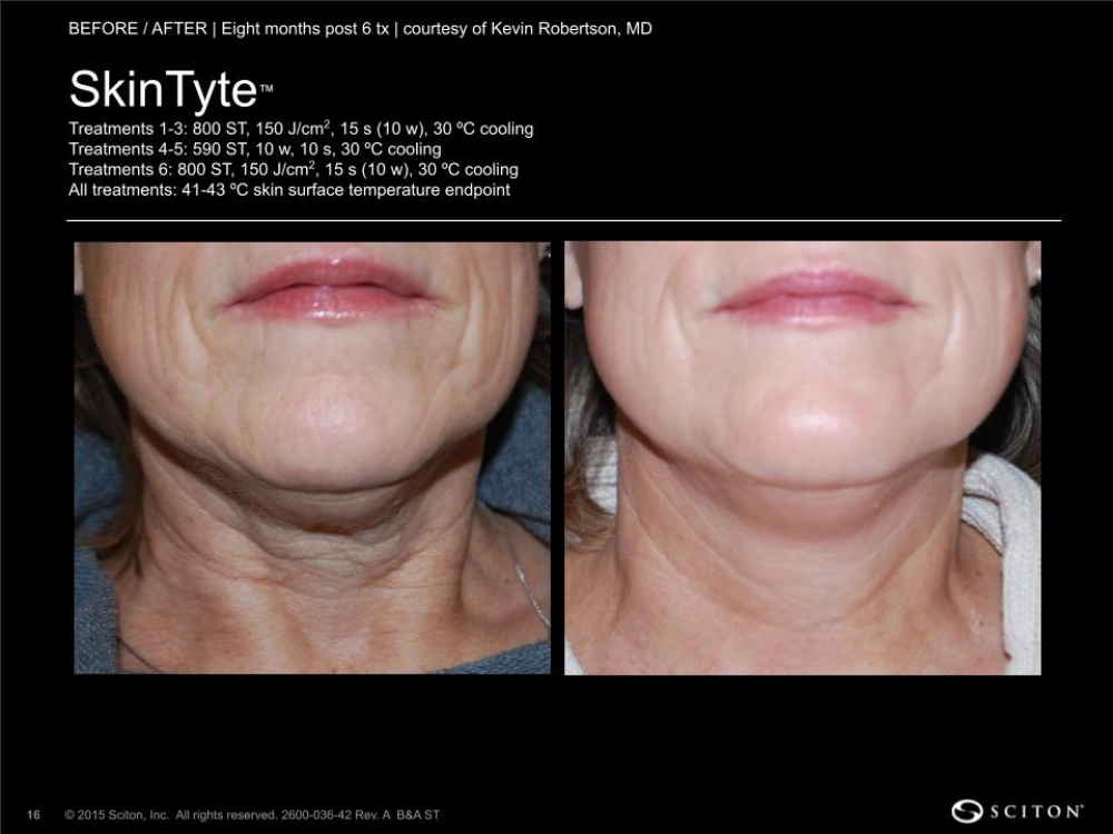 House-Regenerative-Med-Spa-SkinTyte®-By-Sciton-Neck-Before-After-Image-F-in-Chicago-IL