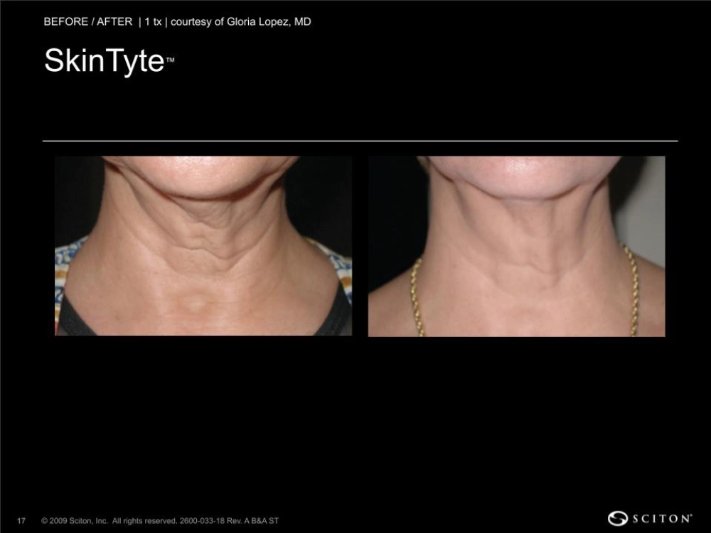 House-Regenerative-Med-Spa-SkinTyte®-By-Sciton-Neck-Before-After-Image-G-in-Chicago-IL