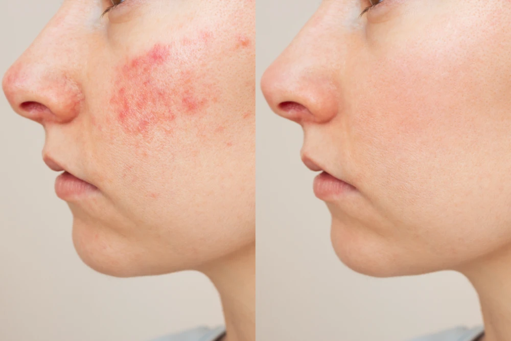Before and after acne facials showing reduced redness and smoother skin.